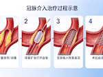 【学科强院】ECMO护航高危PCI！巴医成功救治78岁复杂冠脉病变危重患者